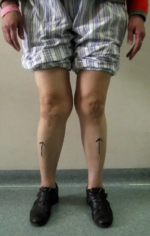 膝外翻病例1 - 好大夫在线