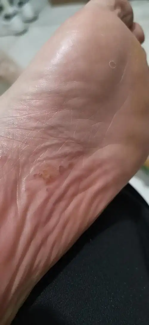 脚底总长小水泡是什么原因