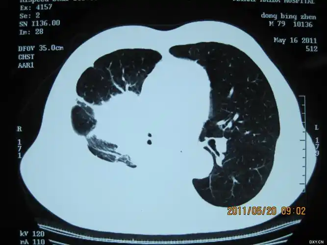 【原创】右肺中央型肺癌 胸腔镜下局部注射治疗