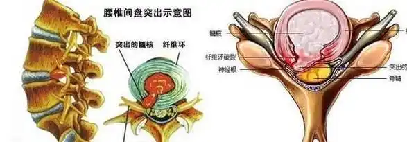 得了腰椎间盘突出,在锻炼,饮食和生活方面要注意哪些?_症状_治疗_患者