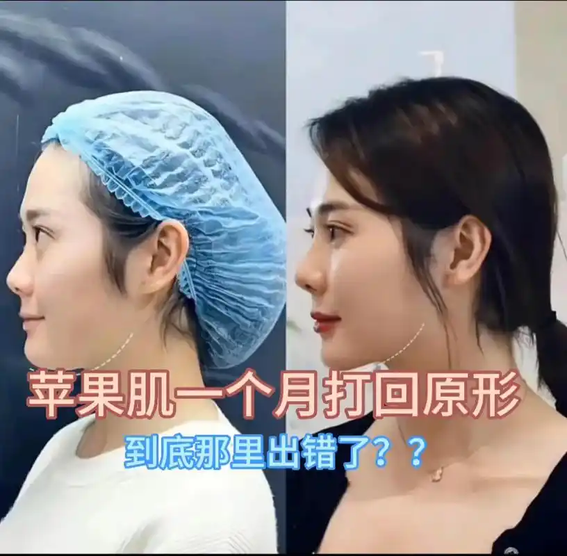 很多姐妹做了苹果肌提升以后往往很快就打回原形,问题到 - 抖音