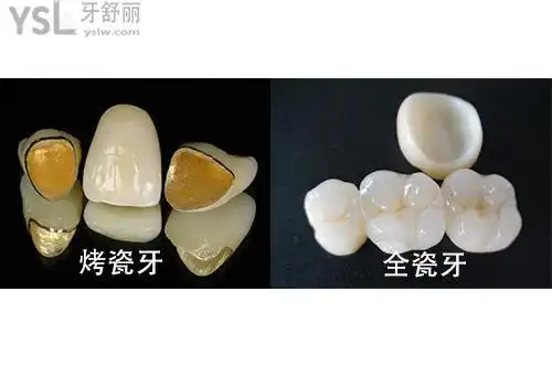 全瓷牙和烤瓷牙有什么不同?哪个更好?
