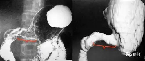 溃疡型:龛影大多成多角形;周围有清楚的环堤;周围皱襞中断,末段呈杵状