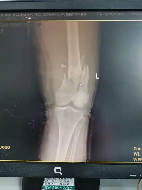 股骨髁上髁间粉碎性骨折