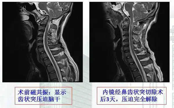 内镜微创治疗颅底凹陷症