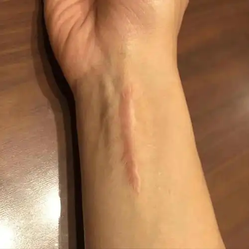 3年顽固疤痕增生打卡90天快速修复!方法简单高效还省钱!