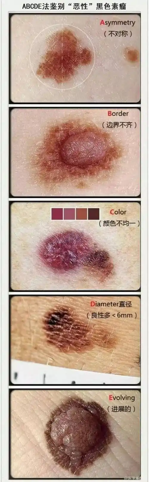 这种痣会害死人,赶紧对照自查吧
