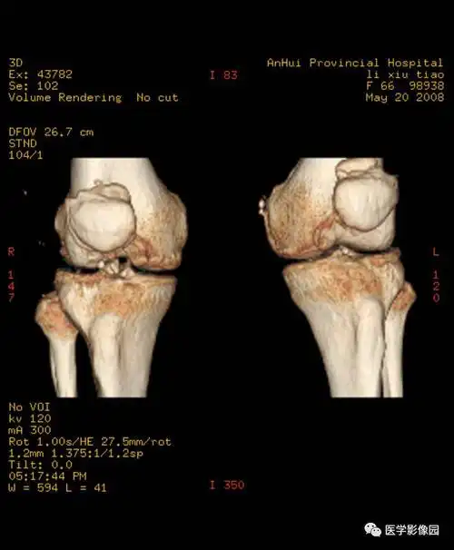 两侧胫骨髁间隆突骨质增生变尖,以右侧为明显(↑),胫骨平台关节面见囊