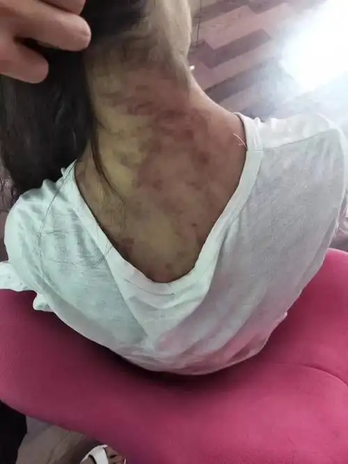 宜宾12岁女孩被后妈毒打,满身伤痕!亲生母亲将要夺回抚养权!