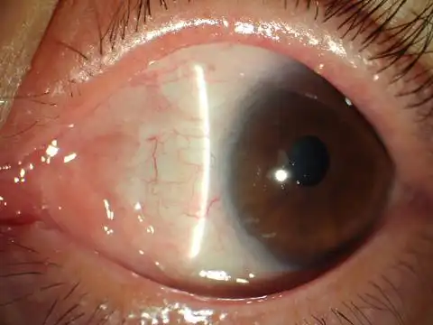 胬肉切除联合自体干细胞移植术后一月附:我院高华博士翼状胬肉手术