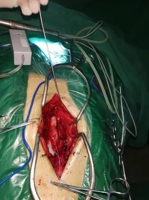 显微镜辅助下的腰椎手术(1)