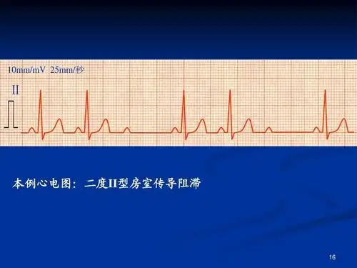房室阻滞ppt_word文档在线阅读与下载_无忧文档