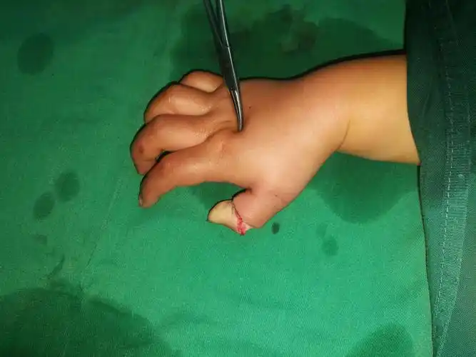 2岁儿童拇指不全离断伤