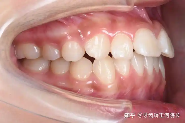 我们可以看到,它的咬合明显是上颌前突,下颌后缩,包括牙齿侧面,我们