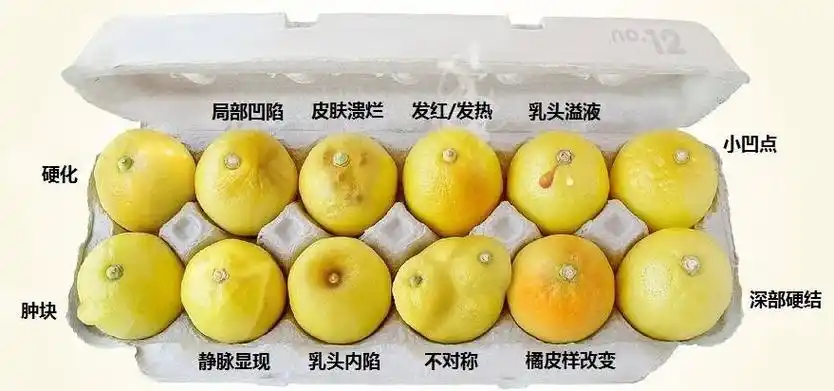 关注乳房健康之 ——正常or不正常?