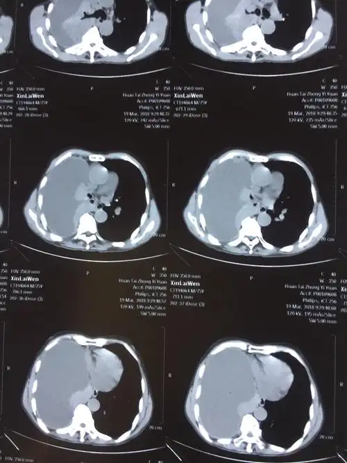 ct示右侧大量胸腔积液,当天行微创胸腔闭式引流术.