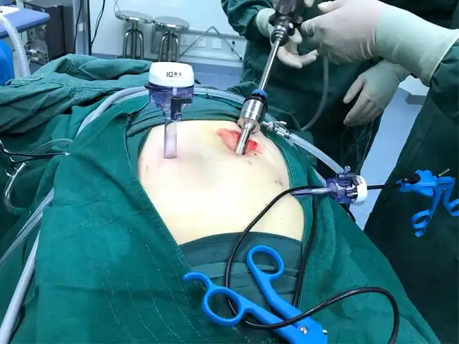 腹腔镜腹股沟疝手术的优势