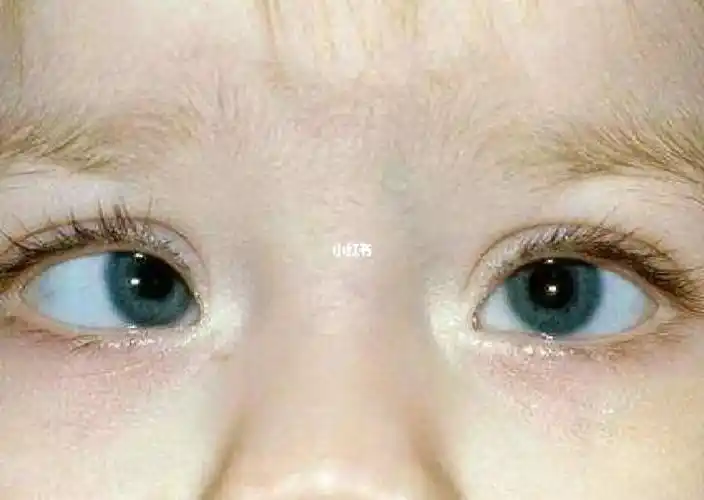 【斜视科普】孩子斜着眼看东西就是斜视吗?