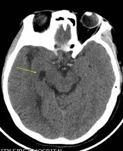 脉络膜裂内的良性囊变,是什么?