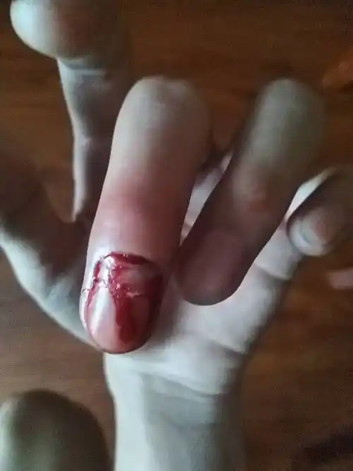 手指甲打球被扯出来了,出了淤血