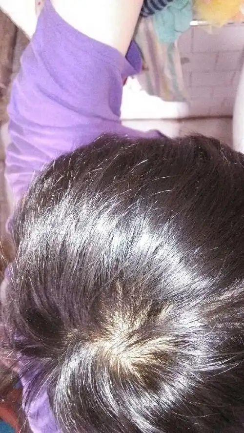 今年16岁,头顶掉头发特别厉害.有什么办法么?