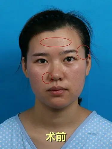 显老的扁平脸如何变年轻立体脸