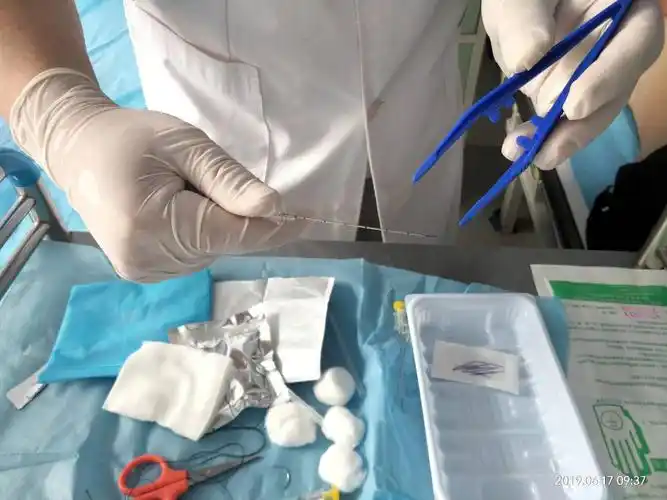 穴位埋线治疗前列腺增生