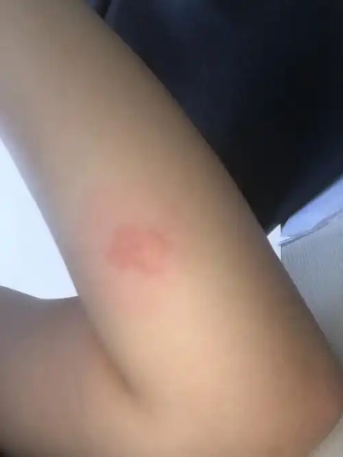 夏天有时候身上会有这种又红又大硬硬得包,不知道什么痒的,两天都下