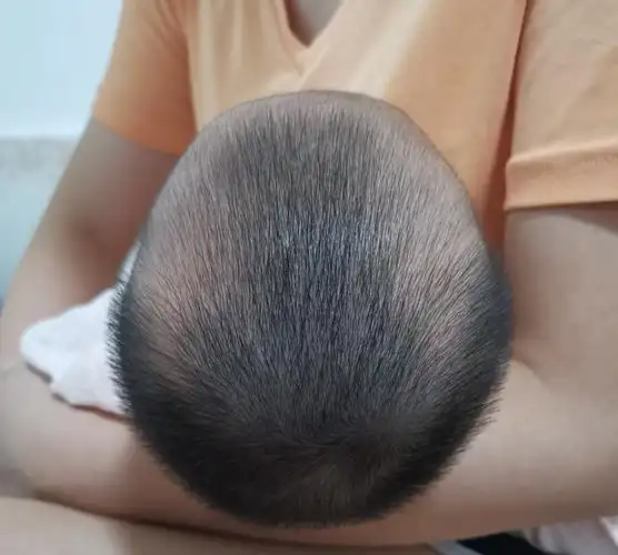 宝宝2个月27天,现在的头型是菱形 偏头 舟状 尖头(头上还有角)