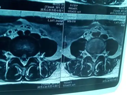 特巨大游离性脱出腰间盘突出症