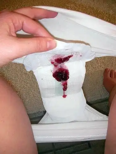 月经来的期间卫生巾上没有血.上厕所小便的时候就有血,怎么回事的?