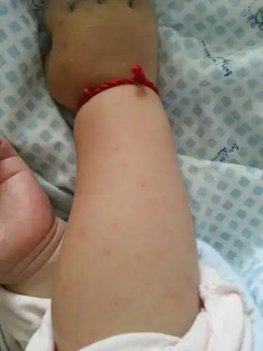 一岁宝宝双臂长满了这种红斑,有人能指导下么