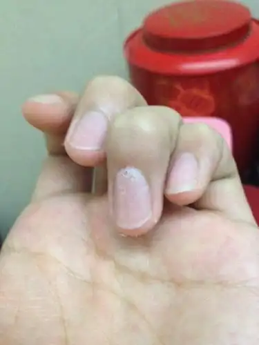 指甲上出现一些白圈,有的还破裂了,指甲上就出现了洞,用牙签轻轻插进