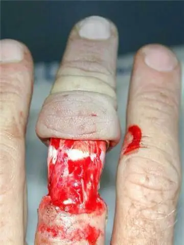 千万不要戴着戒指玩保龄球