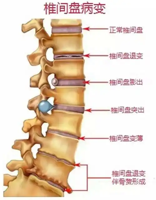 治疗腰椎间盘突出就用这些方法别再动不动就往医院跑