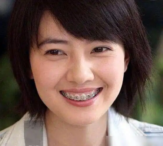 明星整牙堪比整容,高圆圆笑得好看全靠牙,蔡徐坤胡歌似变了个人|唐嫣