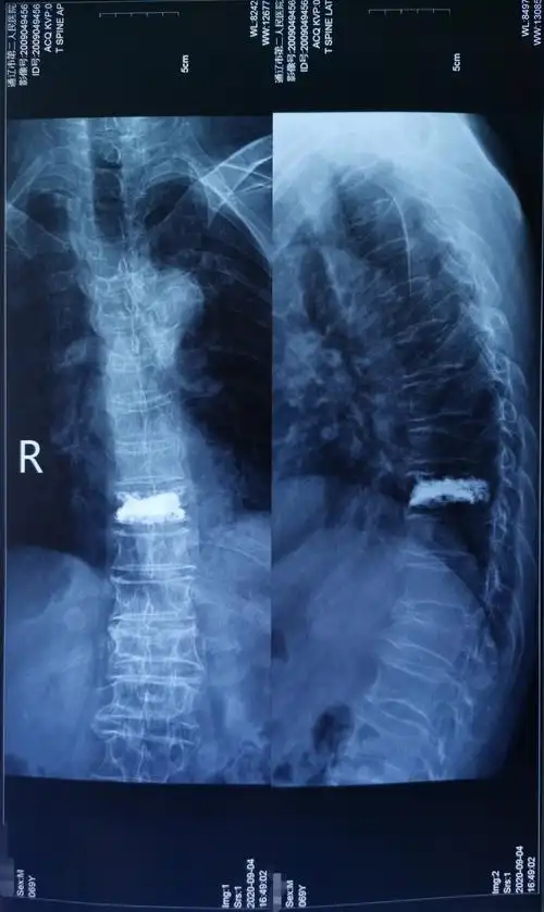 市第二人民医院骨外科为71岁胸9椎体压缩性骨折患者行椎体成型手术,术