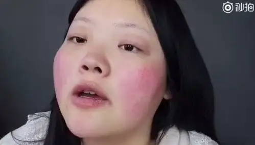 再加上天生红血丝严重,不化妆,简直是个高原红!