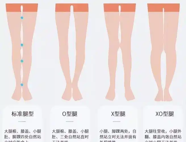 矫正方法:小时候矫正腿型最好.