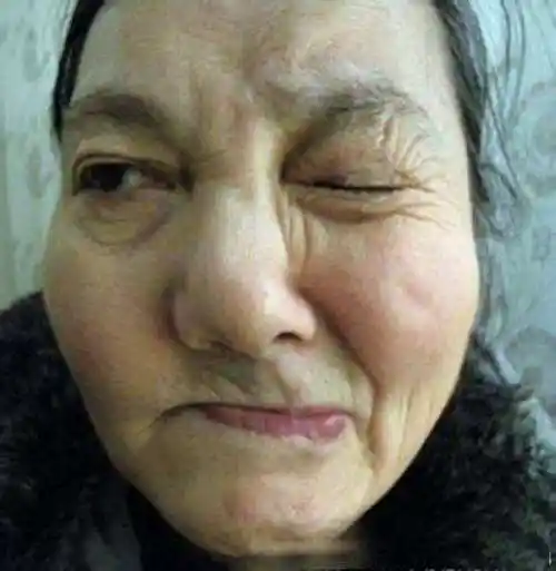 很多人以为面瘫不会带来严重的生理痛苦,因此不当回事,其实面瘫的危害