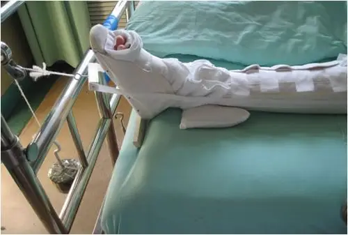 4,保持两腿外展,实施皮牵引,每隔两小时松开牵引带,予以下肢按摩.