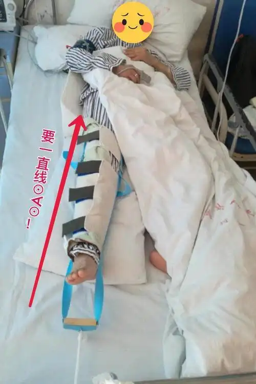 股骨骨折:下肢皮肤牵引,保持腰腿牵引套在一直线,抬高足跟