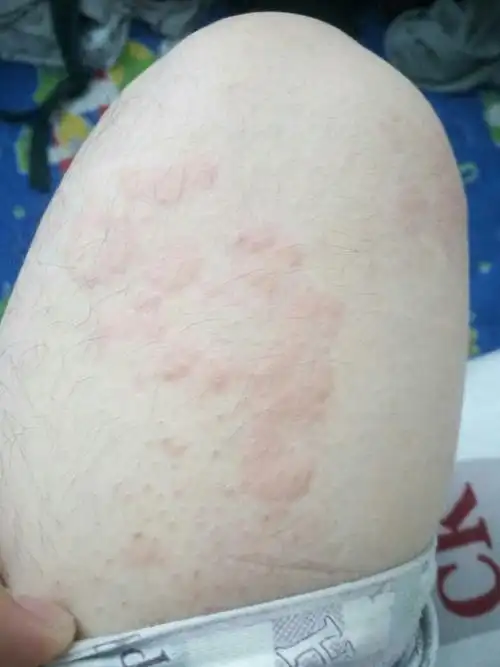 前两天去医院医生说是荨麻疹 开了抗过敏的药 但现在身上还是再起红