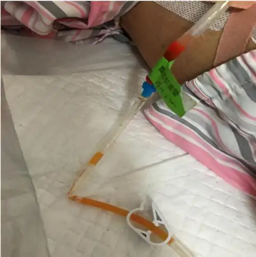 引流条放三天会有感染吗,案例分享:引流管居家护理_b站如何引流-百度