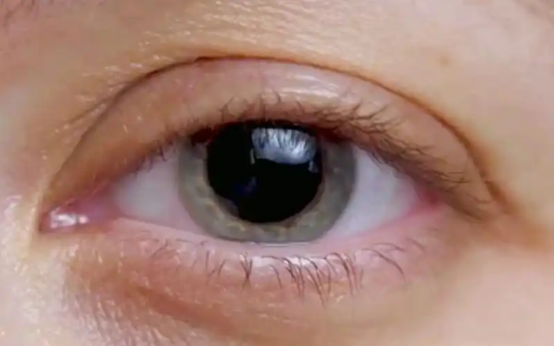 来自眼科检查的外国朋友的散瞳瞳孔