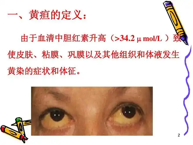 黄疸课件