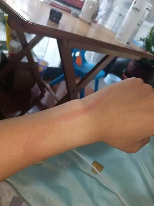 昨天被开水烫伤今天被电蚊拍打了一下