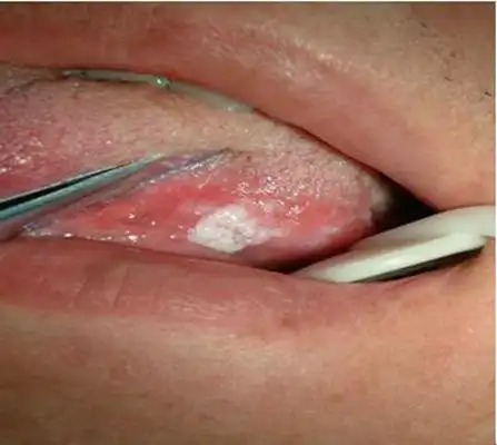 口腔白斑症状,口腔长白斑是什么原因造成的?-图片大观-奇异网