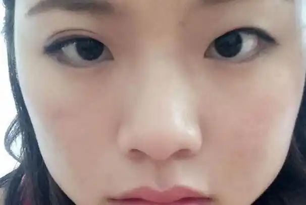 双生痣是什么意思好不好对各项运气有所影响易生双生痣