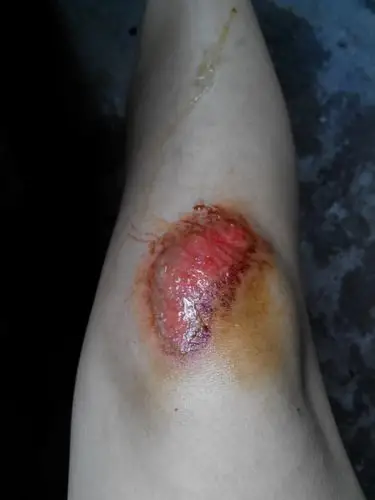 昨天晚上跑步摔了一跤然后脚成这样了已经简单消毒了需要去医院包